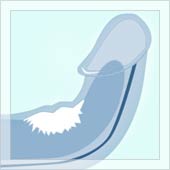 peyronie disease image
